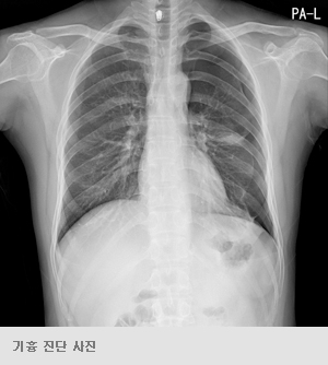 기흉 진단 사진